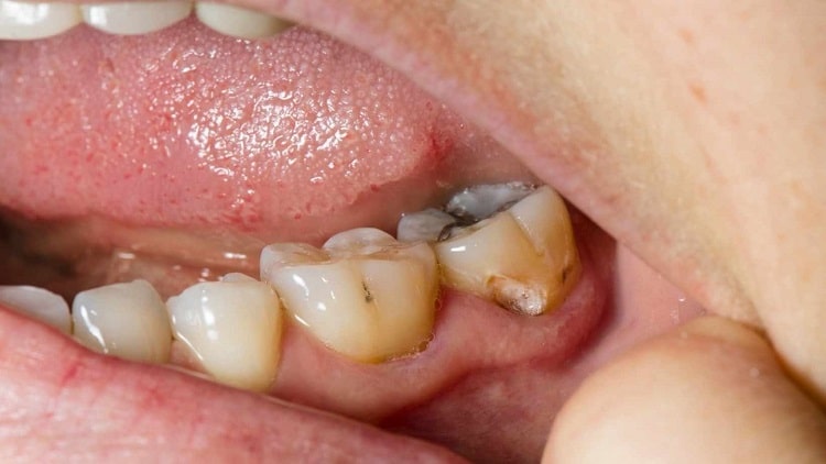 علائم پوسیدگی دندان