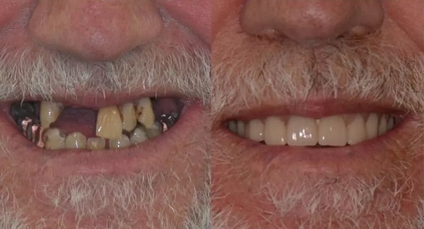 مینی ایمپلنت دندان برای چه افرادی مناسب است؟