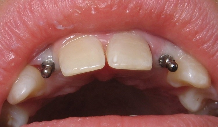 مینی ایمپلنت دندان