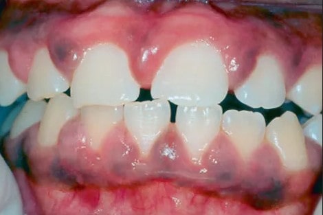 تاثیر بهداشت نامناسب دهان و دندان بر سیاه شدن لثه
