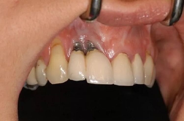 عوارض نادر ایمپلنت دندان