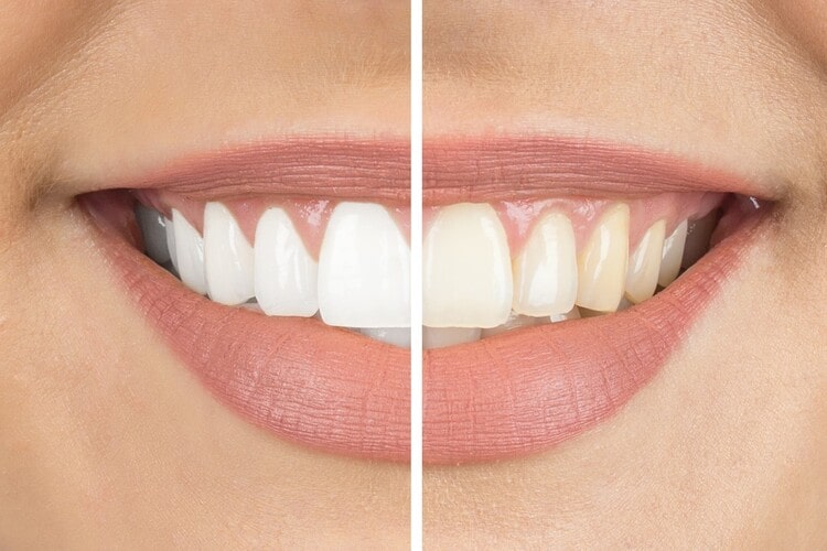 چه افرادی می‌توانند برای سفید کردن دندان اقدام کنند؟