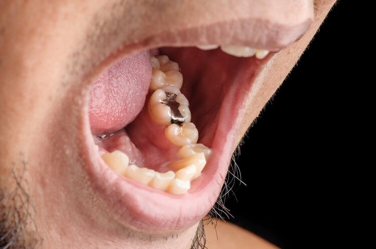 چه زمانی دندان باید ترمیم شود؟