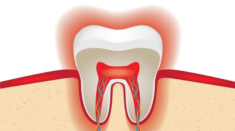 درد عصب دندان