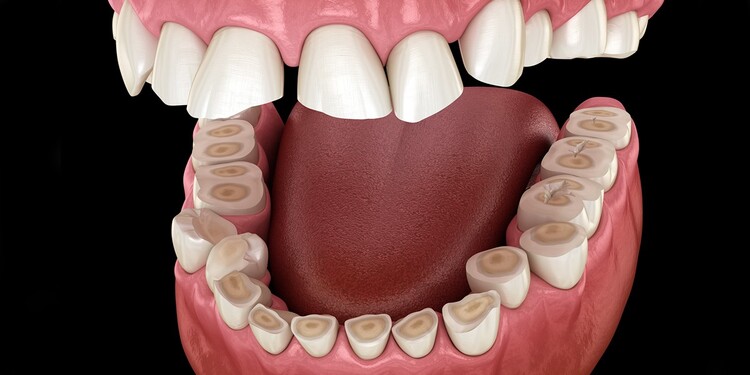 علائم دندان قروچه (براکسیسم)