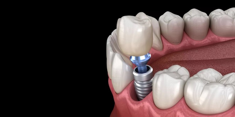 آیا میتوان ایمپلنت دندان را تعویض کرد؟