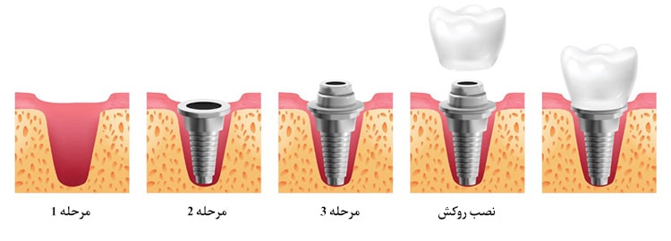 ایمپلنت دندان تک‌ مرحله‌ای