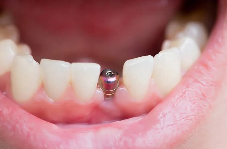 فاصله بین کشیدن دندان تا کاشت ایمپلنت چقدر است؟