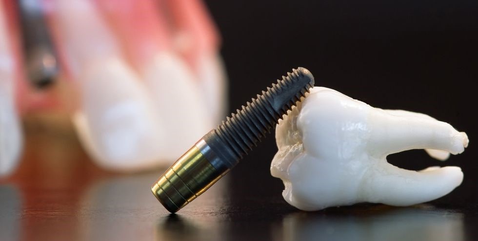 عوامل اصلی مؤثر بر طول عمر ایمپلنت دندان