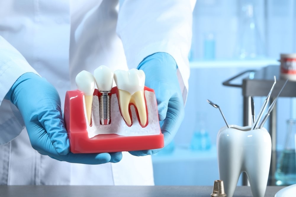درصد موفقیت ایمپلنت دندان و مهم‌ترین عوامل موثر بر موفقیت آن