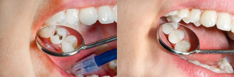 ترمیم دندان با کامپوزیت چیست؟