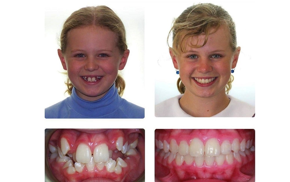 درمان ناهنجاری دندان ها