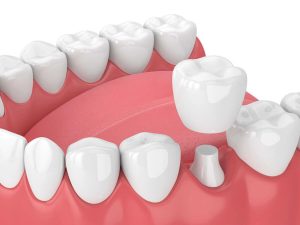 طول عمر روکش دندان به چه عواملی بستگی دارد؟