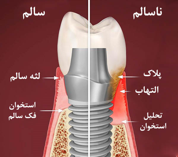 علائم عفونت ایمپلنت دندان و راه‌های درمان آن چیست؟
